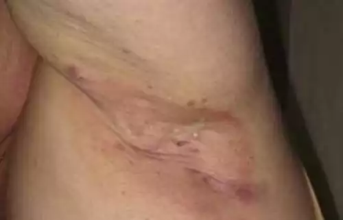 Dr. Eduardo_Hidradenite Supurativa_03