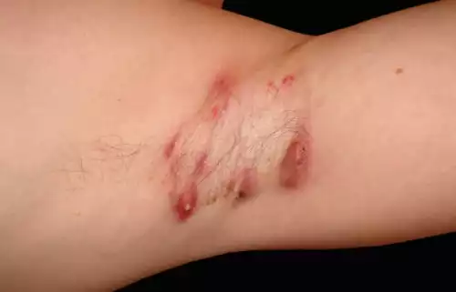 Dr. Eduardo_Hidradenite Supurativa_04